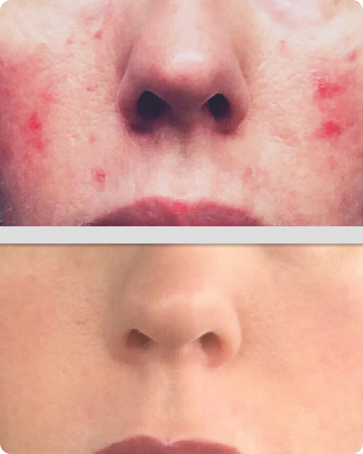 Before and after skin transformation